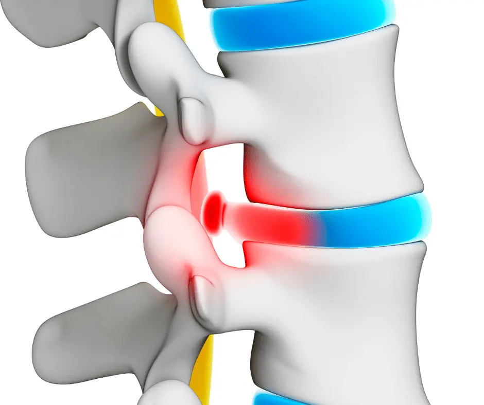 average payout for herniated disc